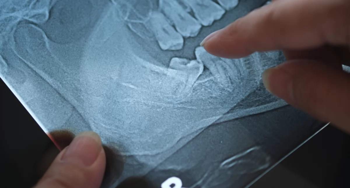 Materiały promocyjne, Tomografia pantomografia zębów dlaczego warto wykonać DenticaNova Starej Iwicznej - zdjęcie, fotografia